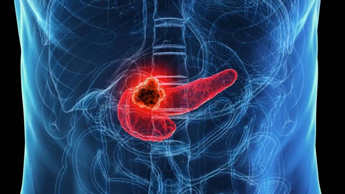 Új mRNS-terápia ígéretes eredményei a hasnyálmirigyrák elleni küzdelemben