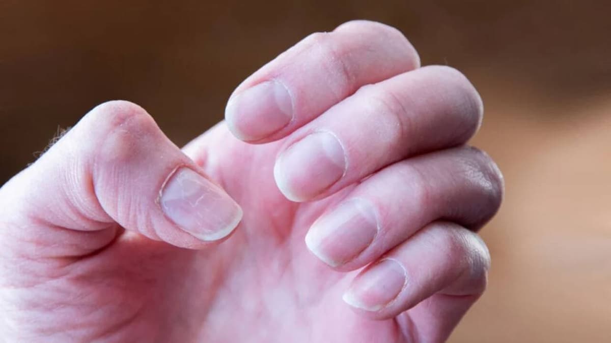 Kézen is jelentkezhet a benőtt köröm: otthoni tippek és mikor forduljunk orvoshoz