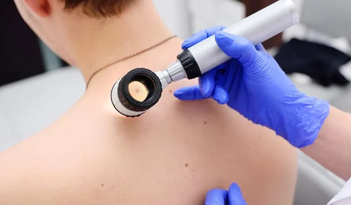 Ingyenes bőrrákszűrést tartanak Ungváron a melanóma világnapja alkalmából