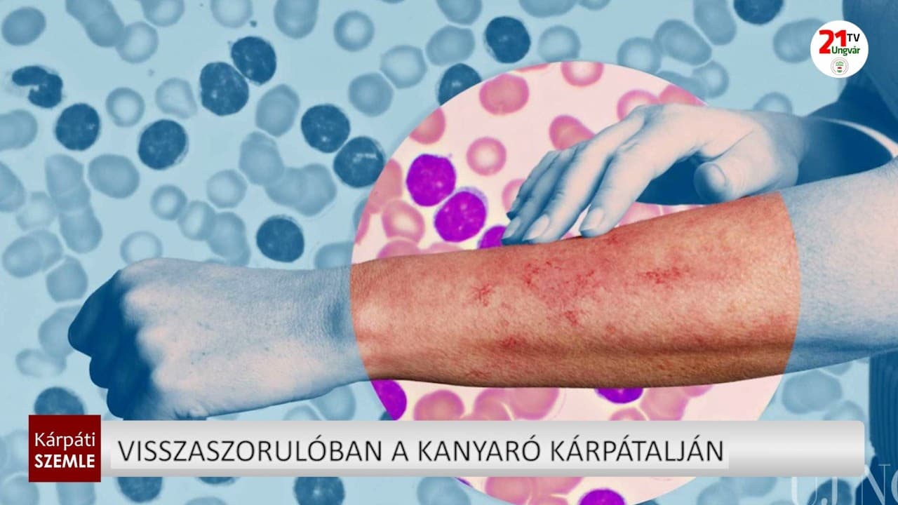 Csökken a kanyarós esetek száma Kárpátalján